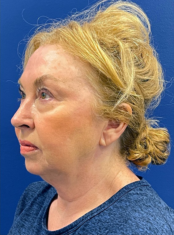 Facelift-Case--22860 | Before Facelift 2