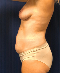 Mommy-Makeover-Case--10461 | Before Mommy Makeover 2