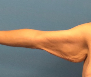 Brachioplasty-Arm-Lift-Case--18182 | Before Arm Lift 1
