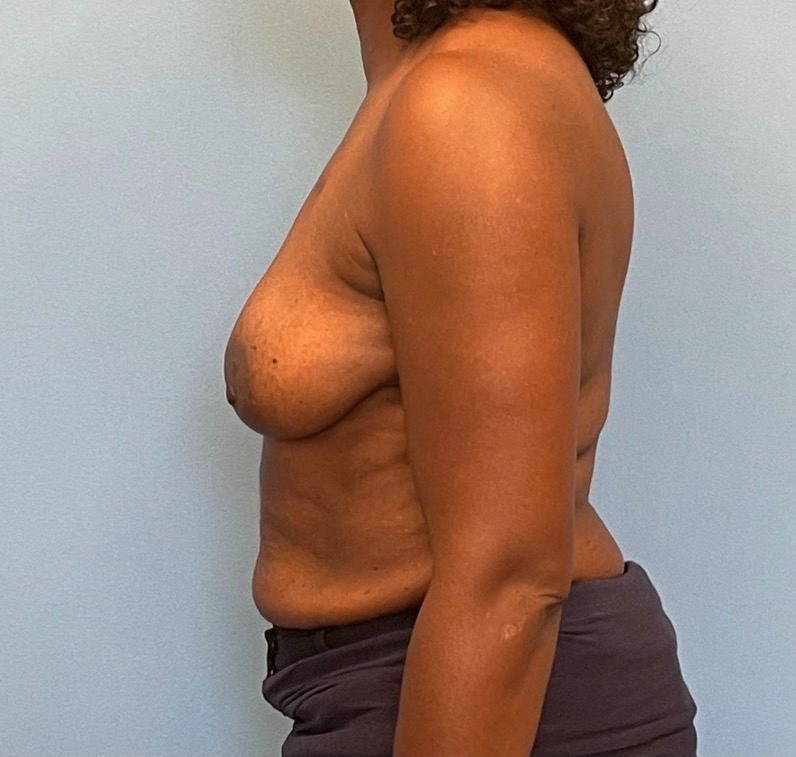 Breast-Reconstruction-Case--23930 | Before Breast Reconstruction 2