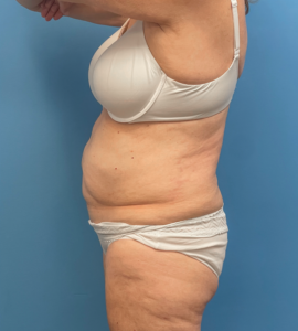 Abdominoplasty-Case--23690 | Before Liposuction 2