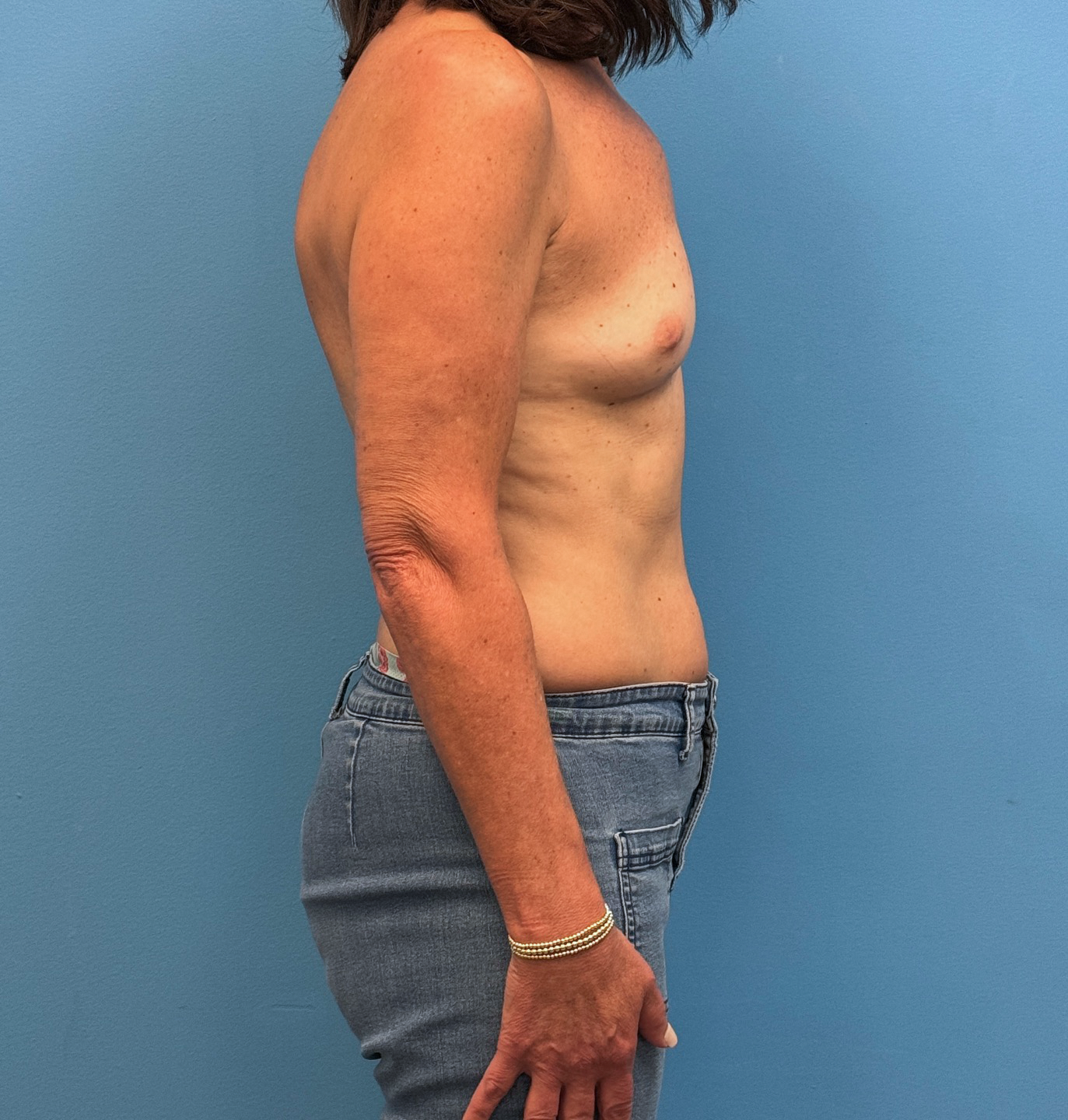 Breast-Reconstruction-Case--28688 | Before Breast Reconstruction 2