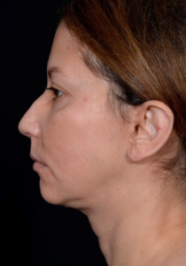 Rhinoplasty-Case--375 | Before Rhinoplasty 1