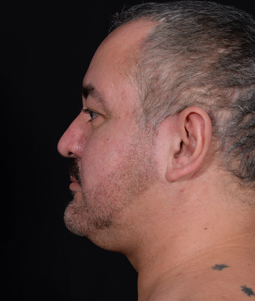 Liposuction-Case--368 | Before Liposuction 2