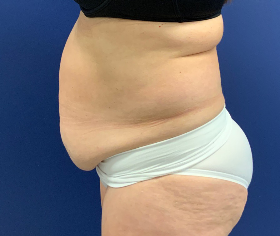 Tummy-Tuck-Case--21804 | Before Tummy Tuck 2