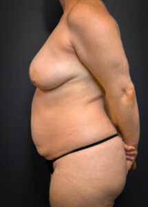 Abdominoplasty-Case--5347 | Before Tummy Tuck 2