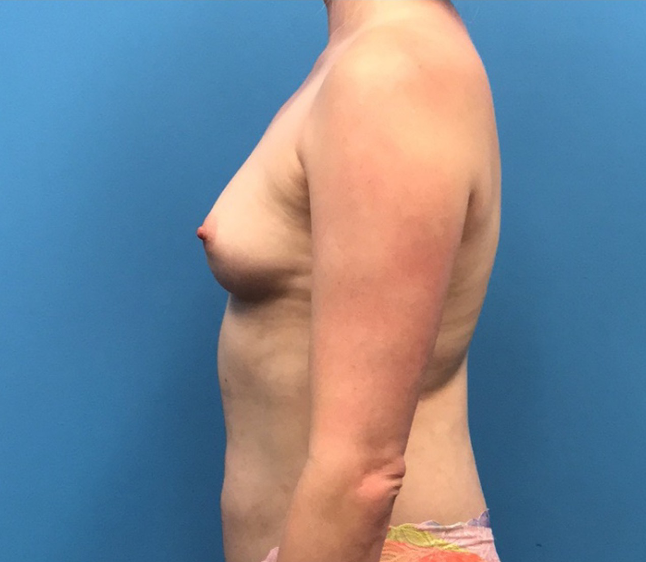 Breast-Augmentation-Case--219 | Before Breast Augmentation 2