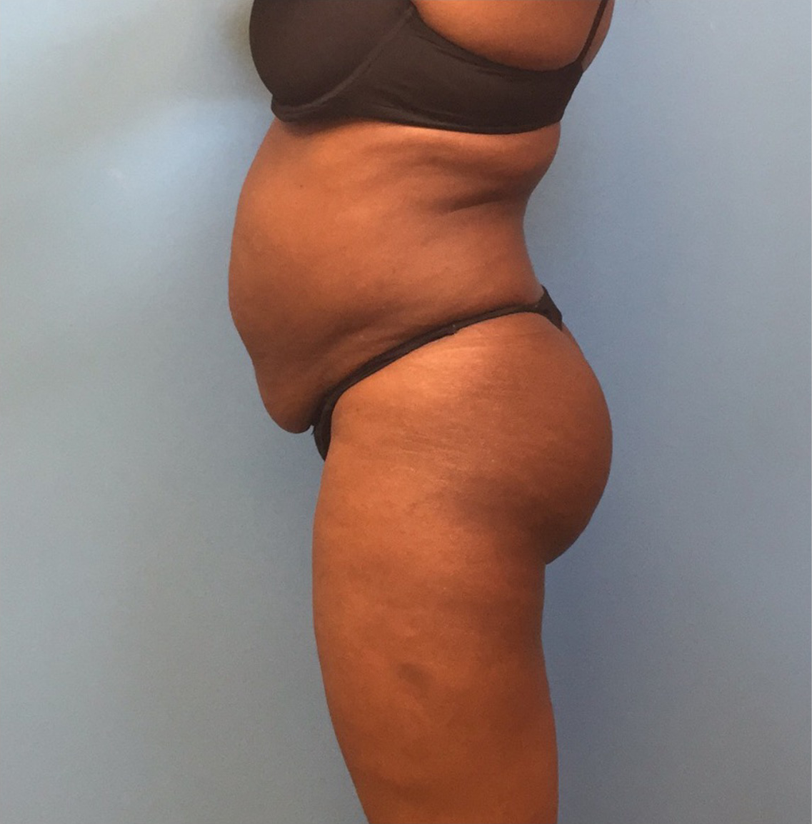 Case--246 | Before Liposuction 2