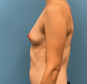 Breast-Reconstruction-Case--25209 | Before Breast Reconstruction 2