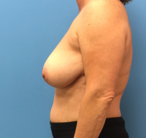 Case--314 | Before Breast Reconstruction 2