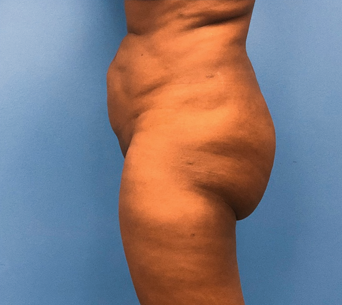 Brazilian-Butt-Lift-Case--267 | Before Brazilian Butt Lift 2