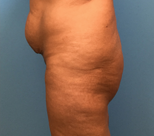 Brazilian-Butt-Lift-Case--74 | Before Brazilian Butt Lift 1