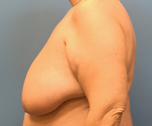 Breast-Reduction-Case--130 | Before Breast Reduction 2