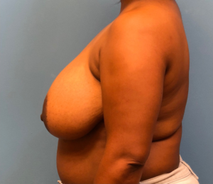 Breast-Reduction-Case--12894 | Before Breast Reduction 2