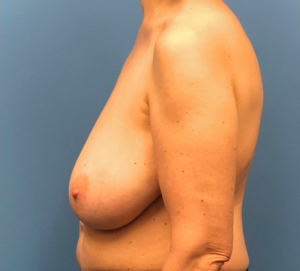 Breast-Reduction-Case--13180 | Before Breast Reduction 2