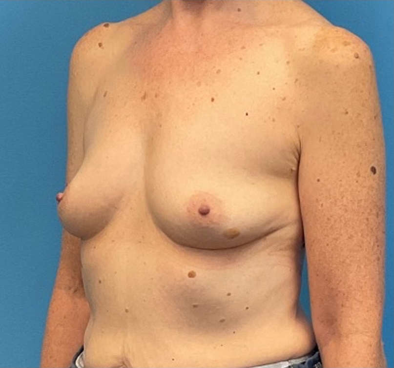Breast-Augmentation-Case--27374 | Before Breast Augmentation 2