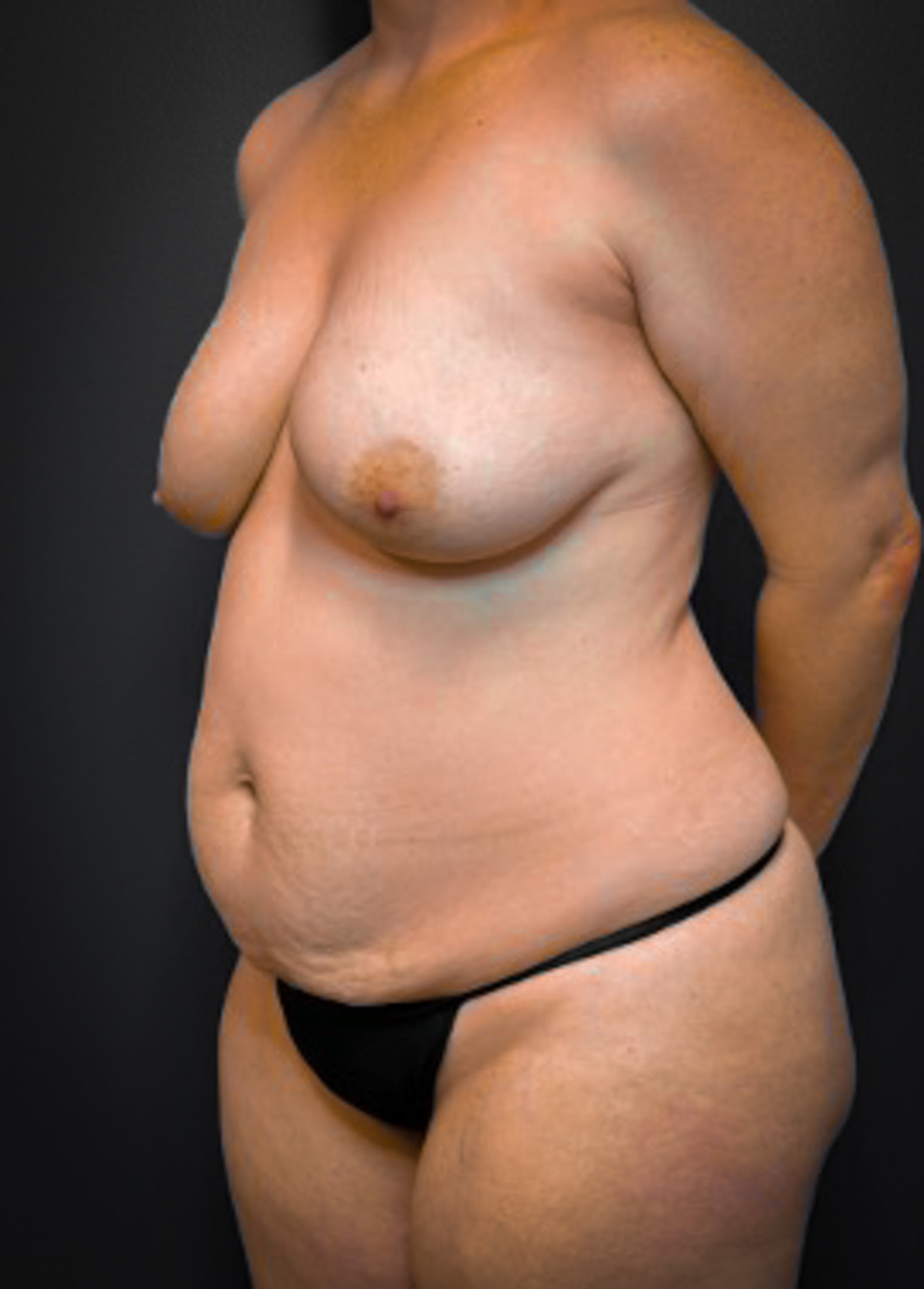 Abdominoplasty-Case--5347 | Before Tummy Tuck 4