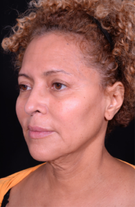 Facelift-Case--360 | Before Facelift 2