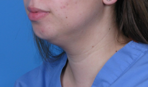 Case--293 | Before Submental Liposuction 2