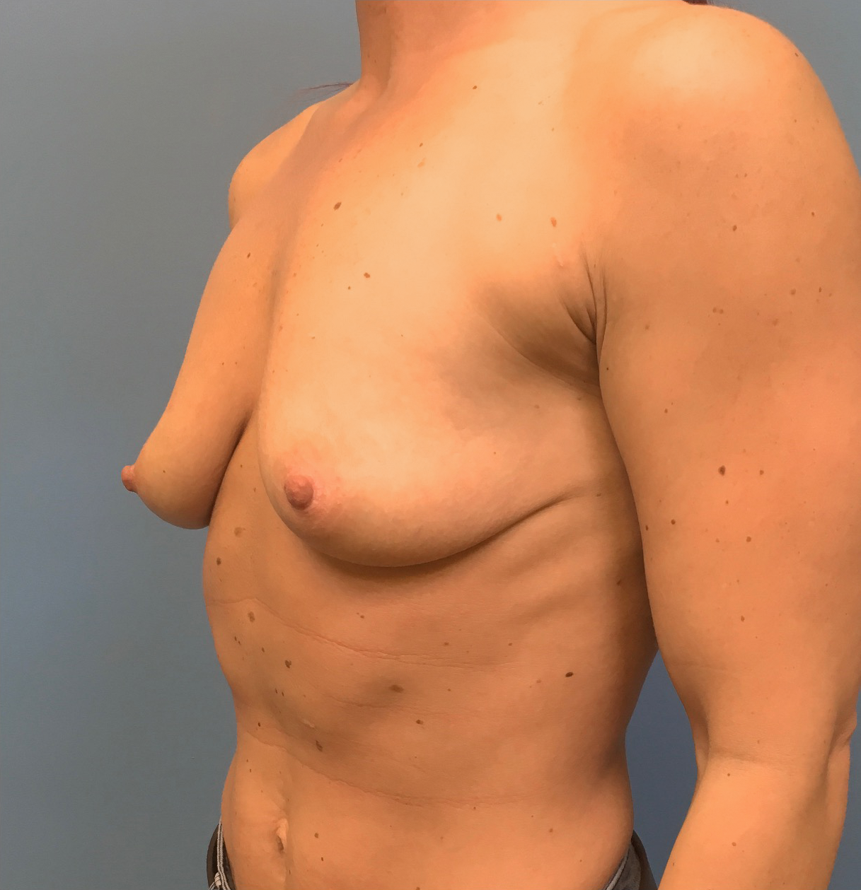 Case--17251 | Before Breast Augmentation 2