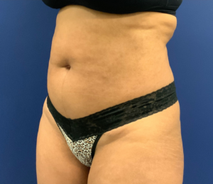 Lipoabdominoplasty-Case--21755 | Before Tummy Tuck 2