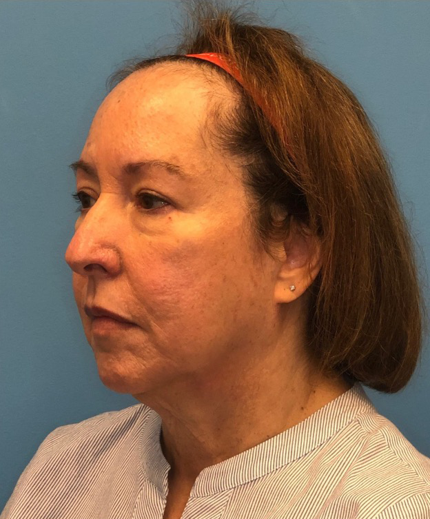 Facelift-Case--21241 | Before Facelift 2