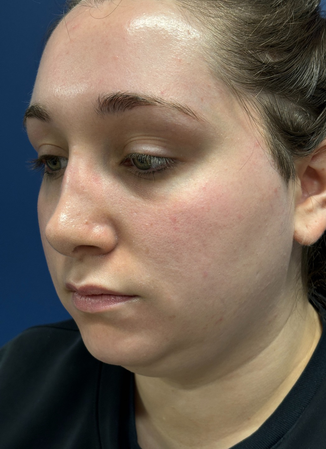 Submental-Liposuction-Case--29107 | Before Liposuction 1