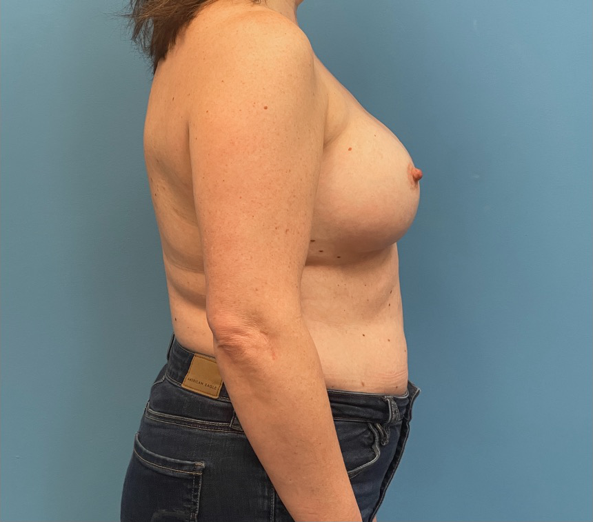 Breast-Reconstruction-Case--27065 | Before Breast Reconstruction 2
