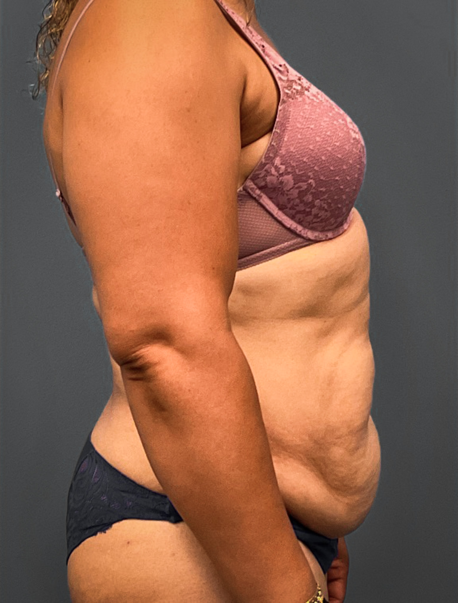 Abdominoplasty-Case--2637 | Before Tummy Tuck 2