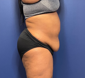 Lipoabdominoplasty-Case--245 | Before Liposuction 2