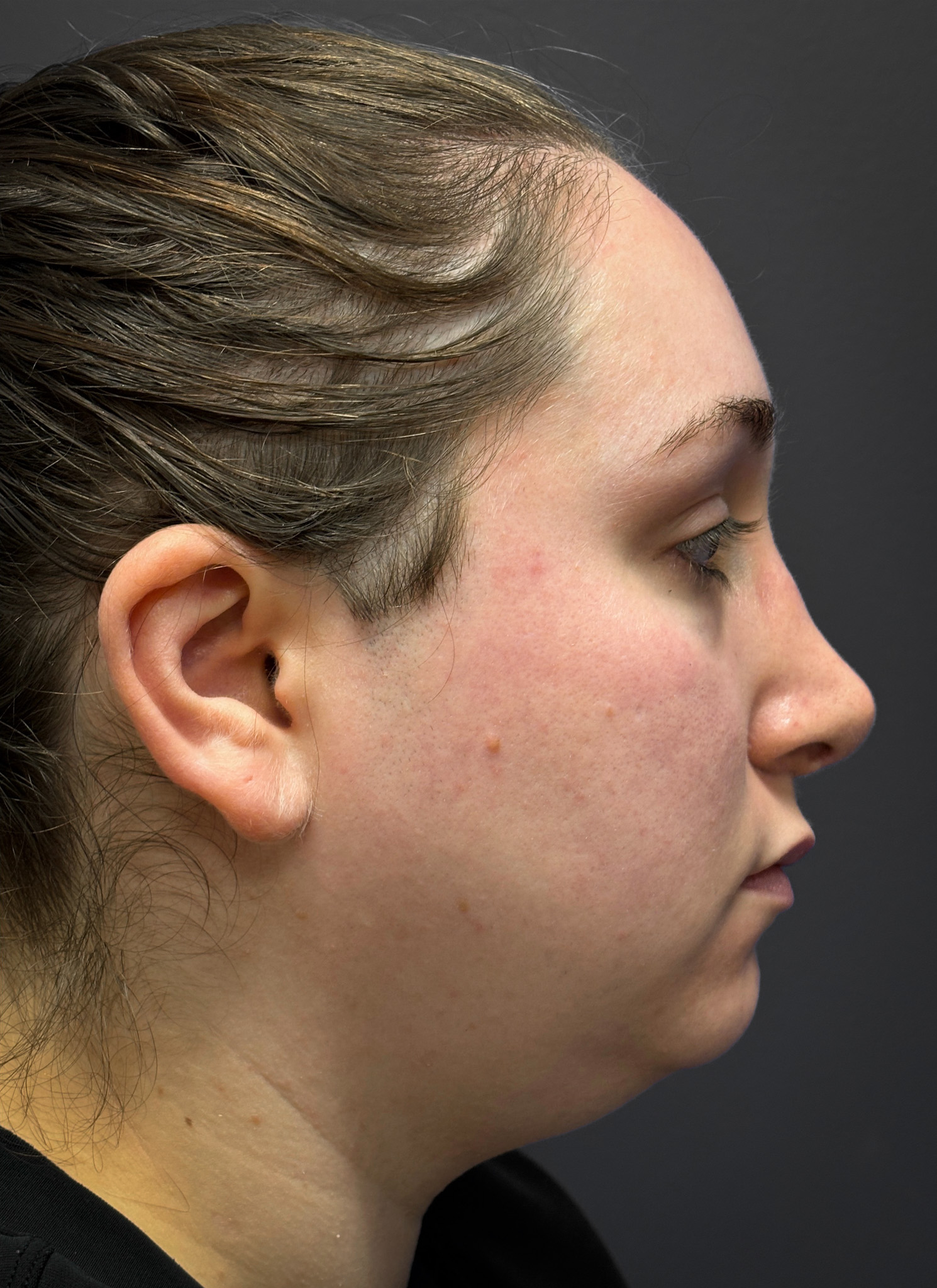 Submental-Liposuction-Case--3439 | Before Liposuction 2