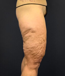 Thighplasty-Case--2024 | Before Thigh Lift 2