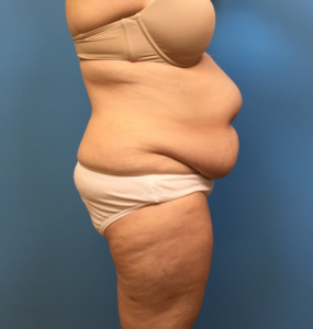 Case--249 | Before Liposuction 2