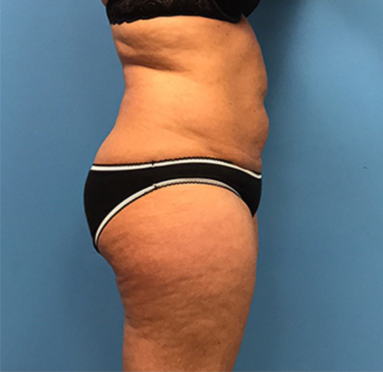Liposuction-Case--72-1 | Before Liposuction 2