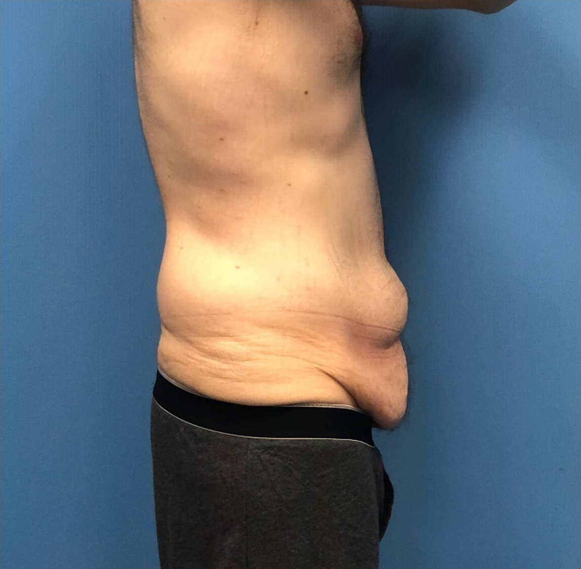 Body-Lift-Case--273 | Before Tummy Tuck 2