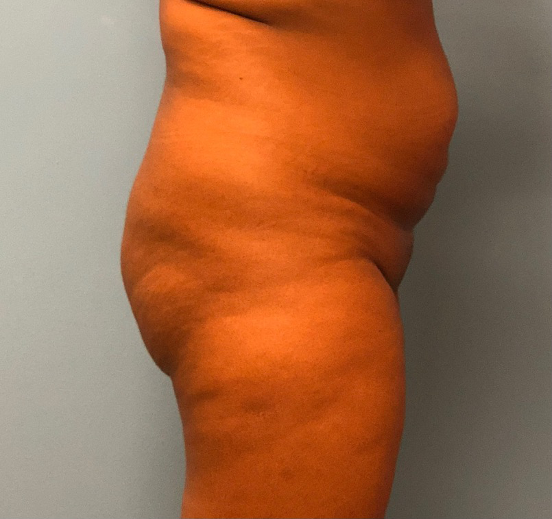 Brazilian-Butt-Lift-Case--13244 | Before Brazilian Butt Lift 2