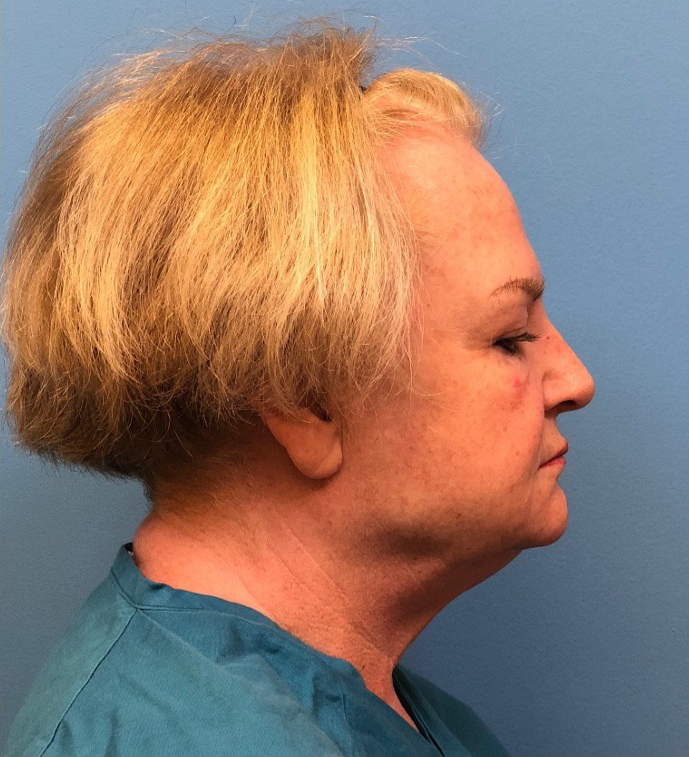 Facelift-Case--14460 | Before Facelift 2