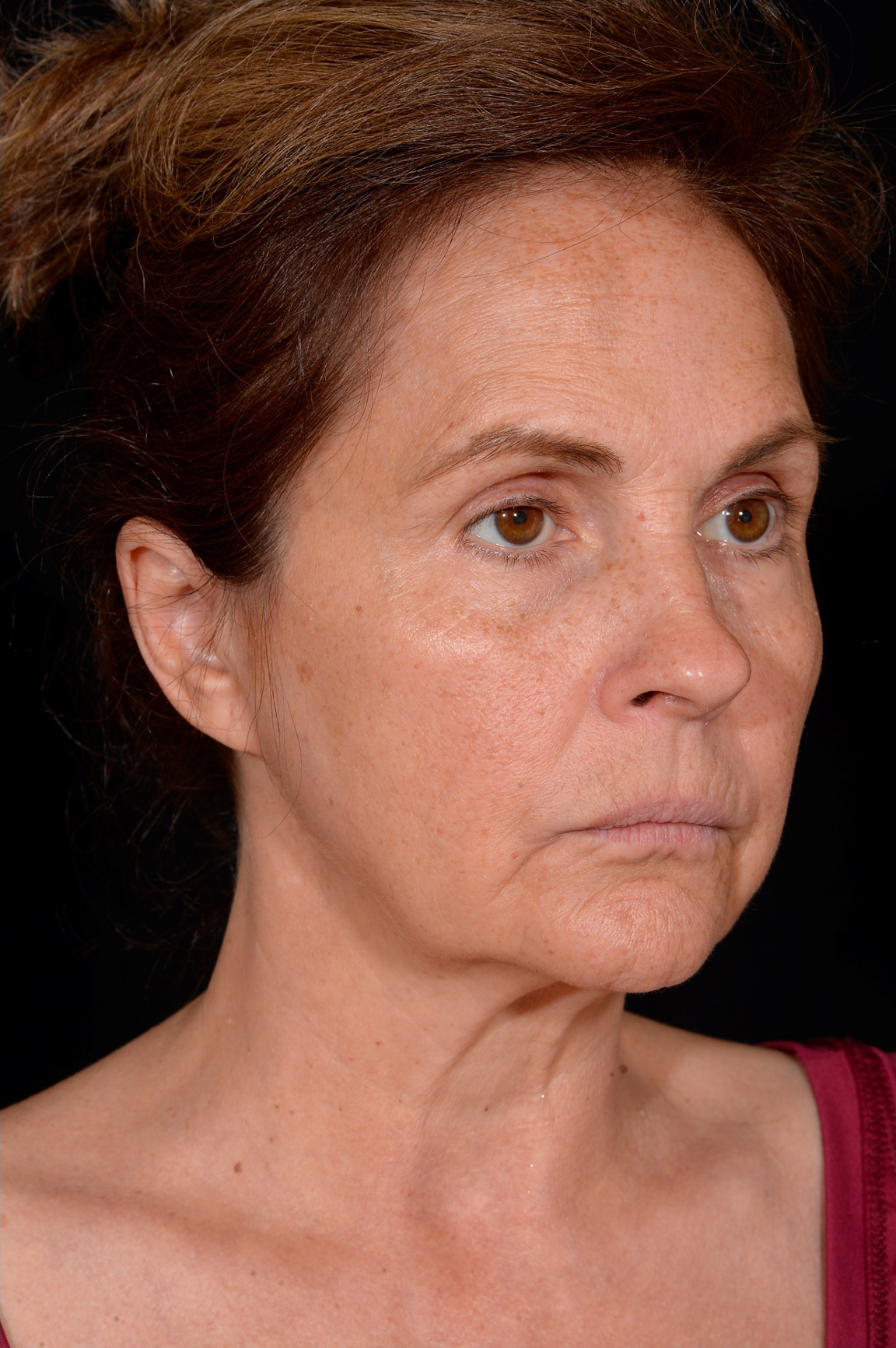 Facelift-Case--361 | Before Facelift 2