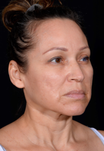 Facelift-Case--364 | Before Facelift 2