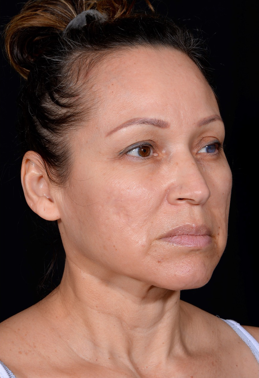 Facelift-Case--364 | Before Facelift 2