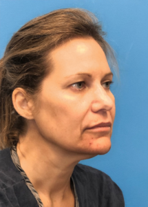 Facelift-Case--18078 | Before Facelift 2