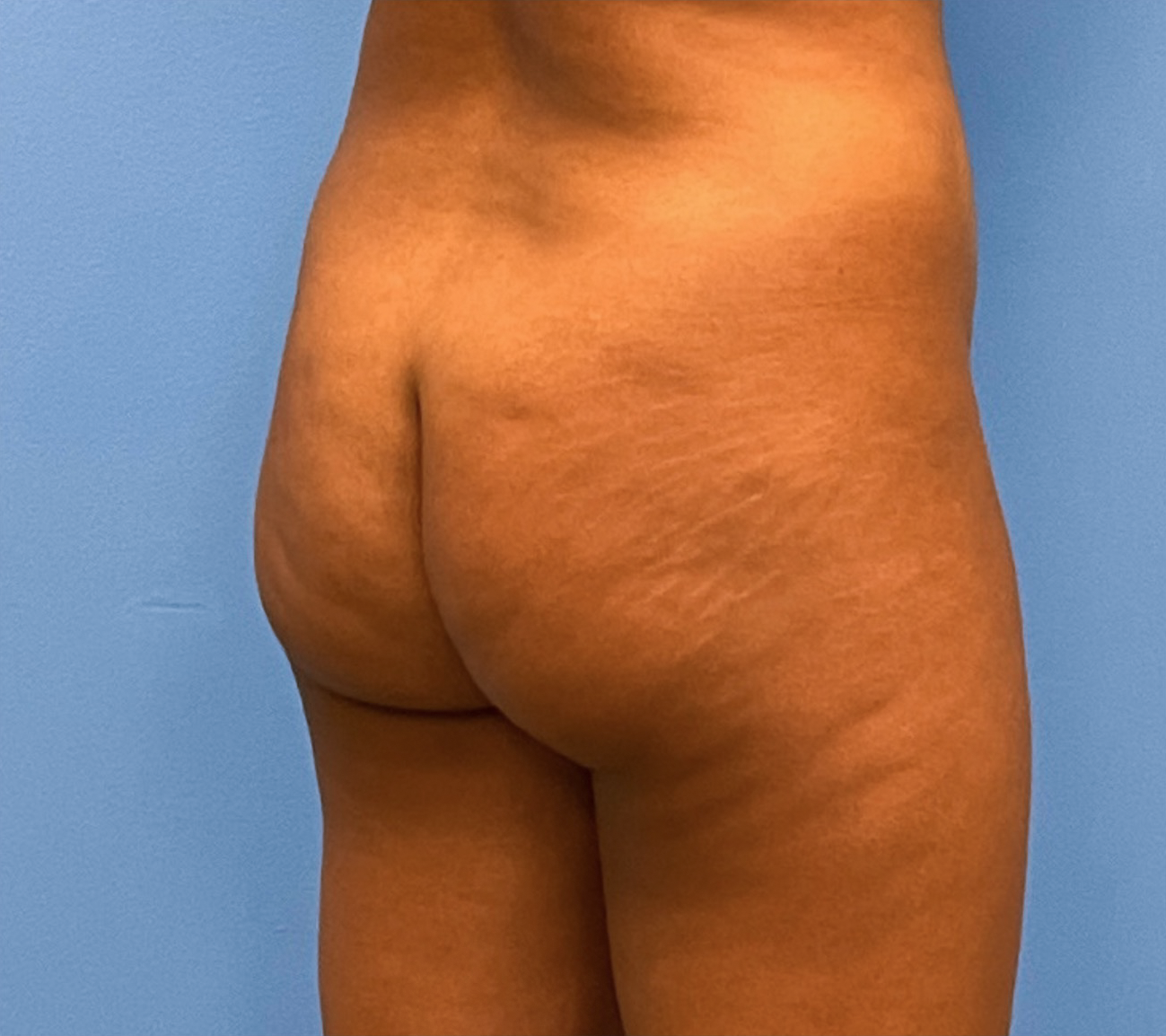 Brazilian-Butt-Lift-Case--263 | Before Brazilian Butt Lift 2