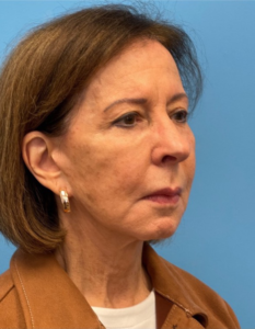 Facelift-Case--25941 | Before Facelift 2