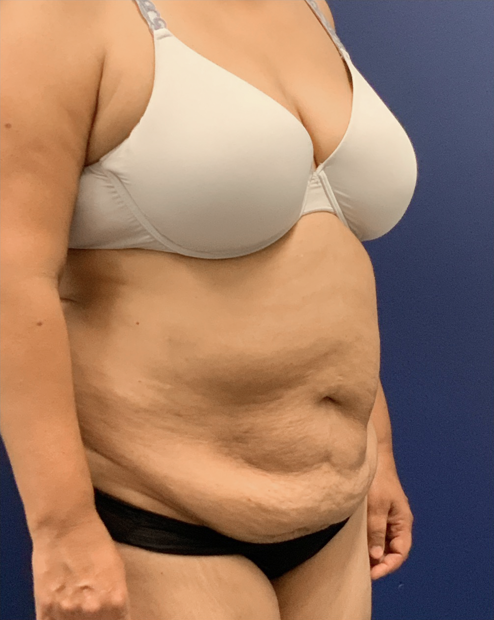 Liposuction-Tummy-Tuck-Case--25576 | Before Liposuction 2