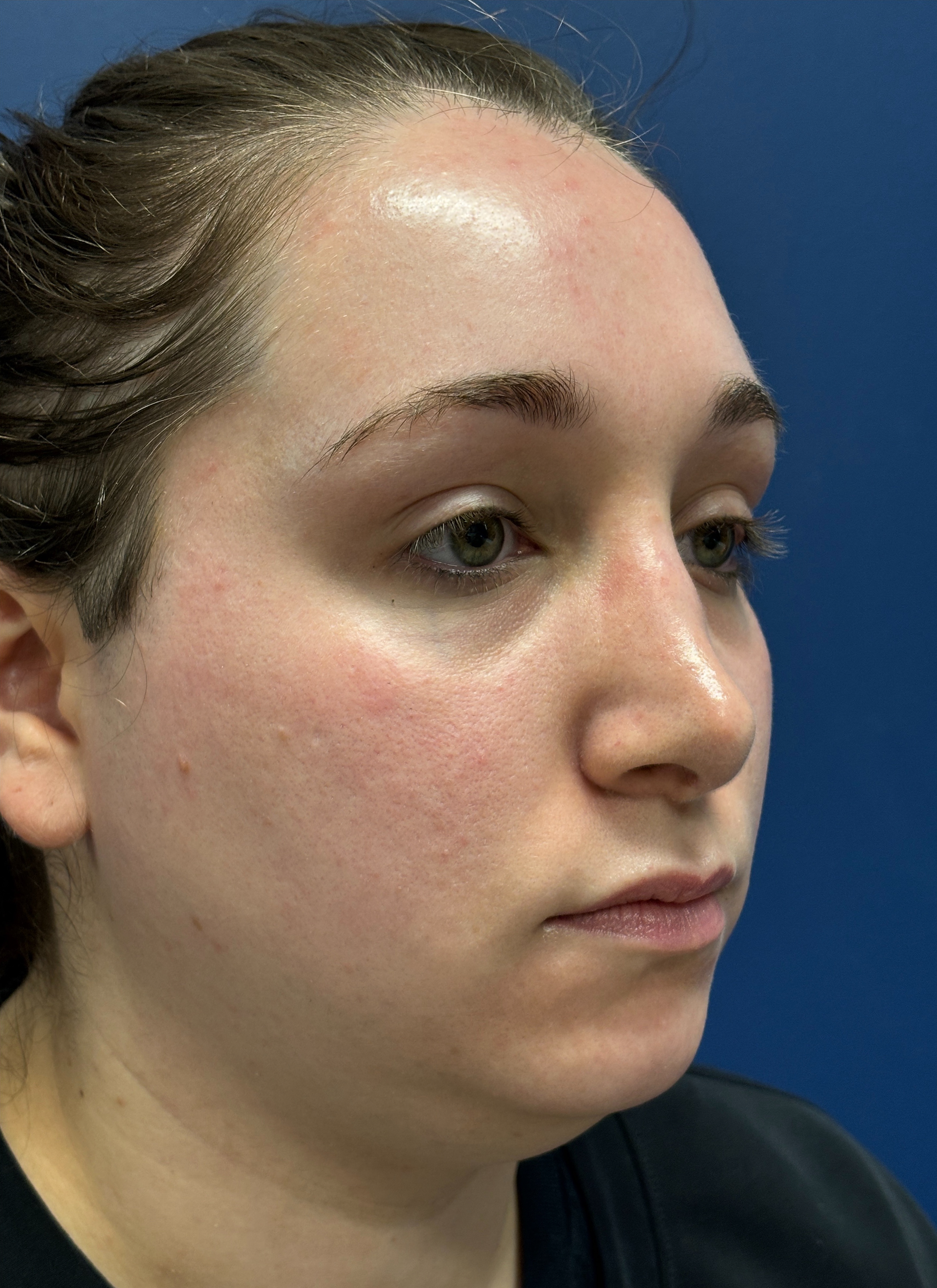 Submental-Liposuction-Case--29107 | Before Liposuction 2