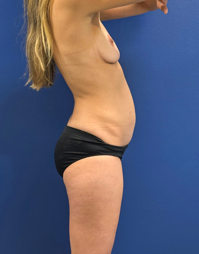 Breast-Augmentation-Tummy-Tuck-Case--29010 | Before Breast Augmentation With Lift 7