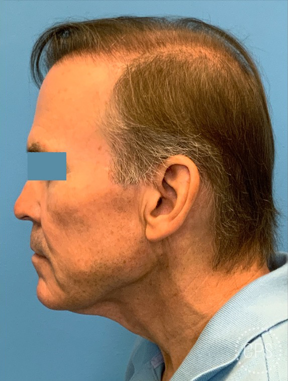 Men-Neck-Face-Lift-Case--23753 | Before Facelift 1