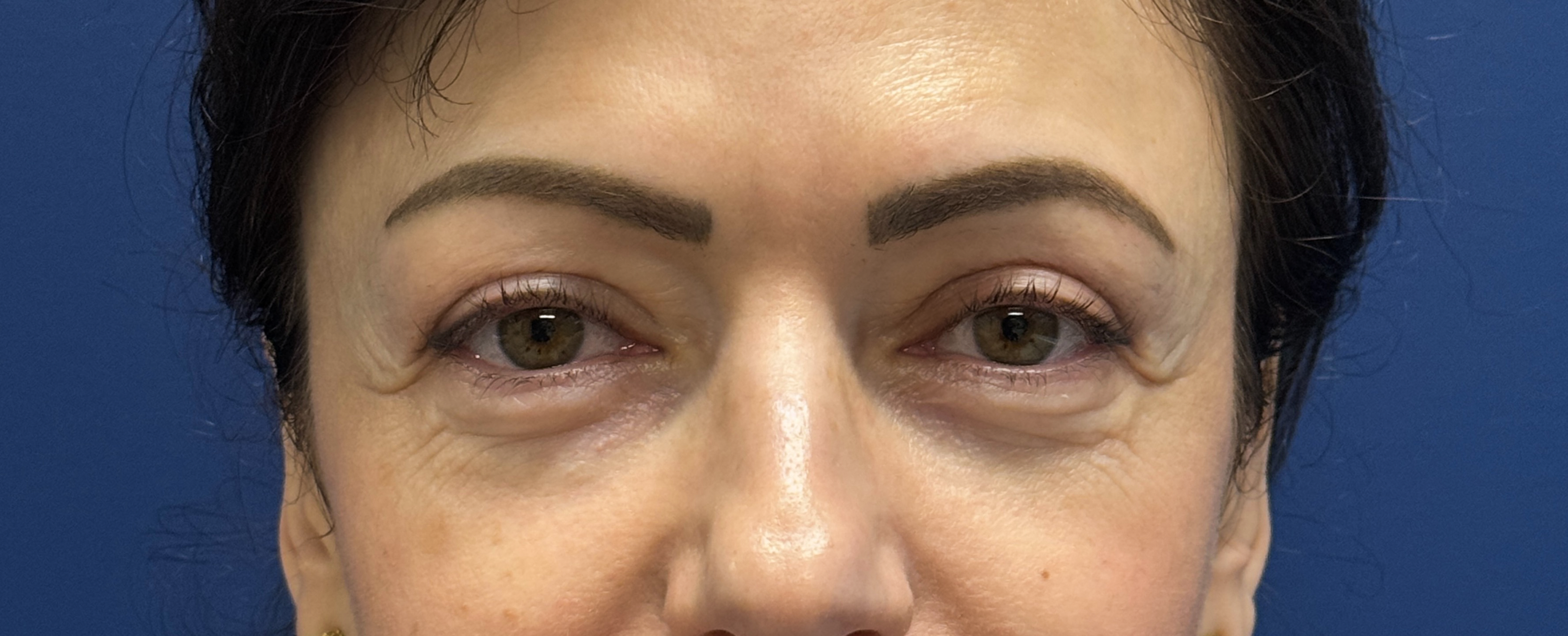 Lower-Blepharoplasty-Case--26939-1 | Before Eyelid Surgery 2