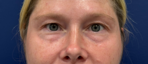 Blepharoplasty-Case--29601 | Before Eyelid Surgery 2