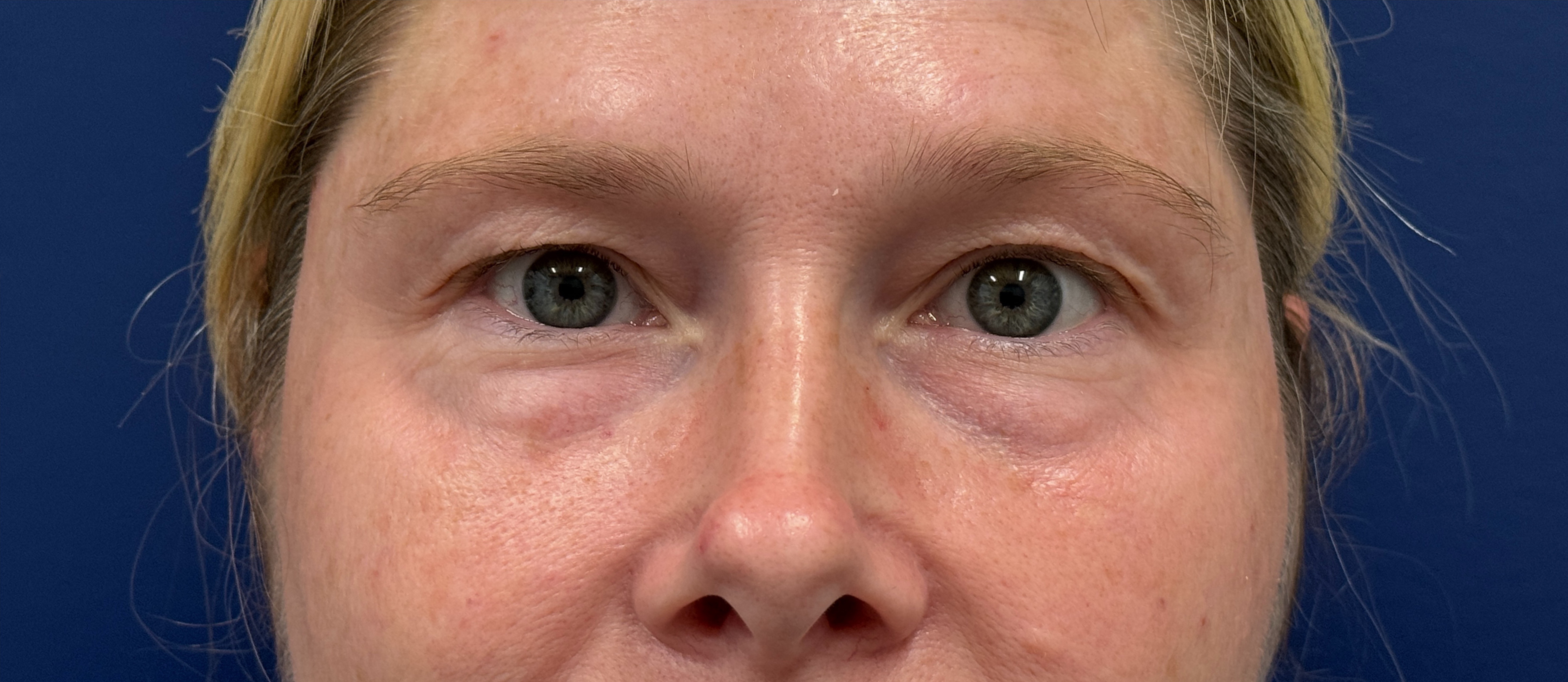 Blepharoplasty-Case--29601 | Before Eyelid Surgery 2